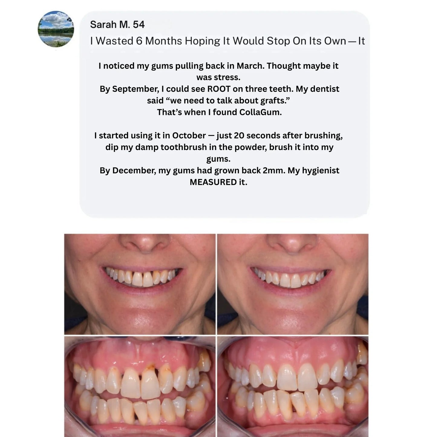 CollaGum™ Gingival Collagen Powder — Gum Recession & Tissue Rebuilding