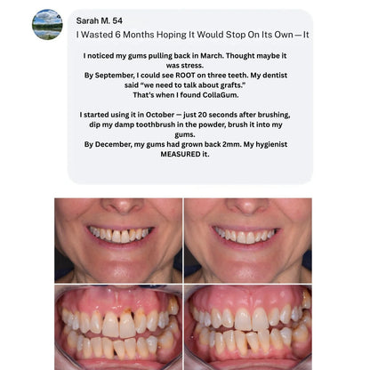 CollaGum™ Gingival Collagen Powder — Gum Recession & Tissue Rebuilding