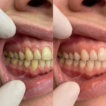 CollaGum™ Gingival Collagen Powder — Gum Recession & Tissue Rebuilding